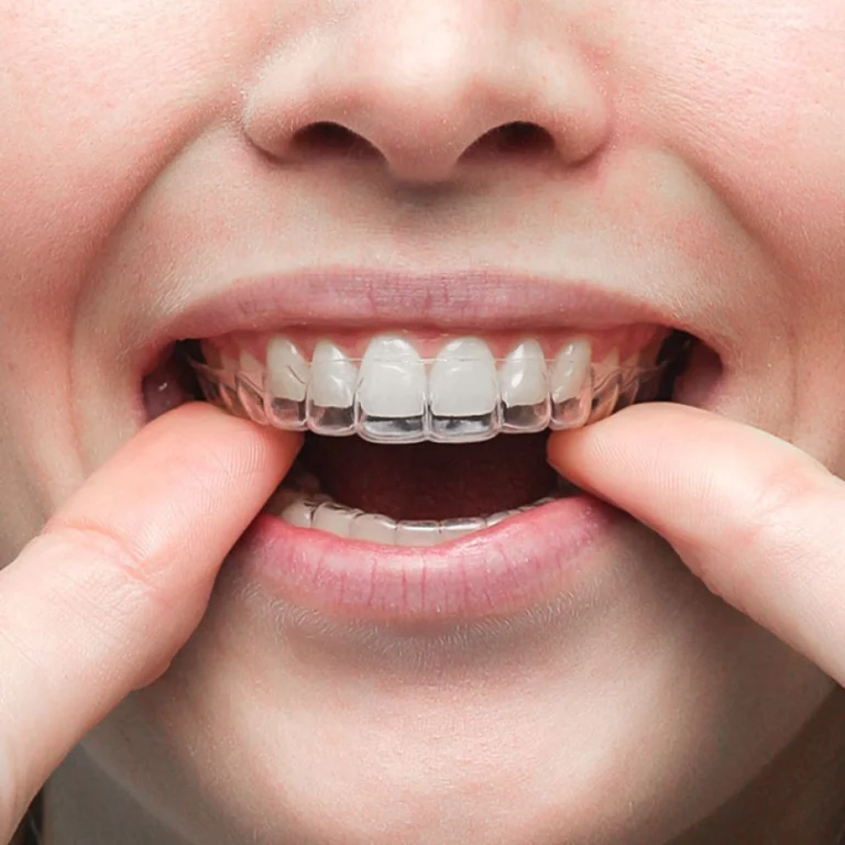 estetiek-onzichtbare-beugel