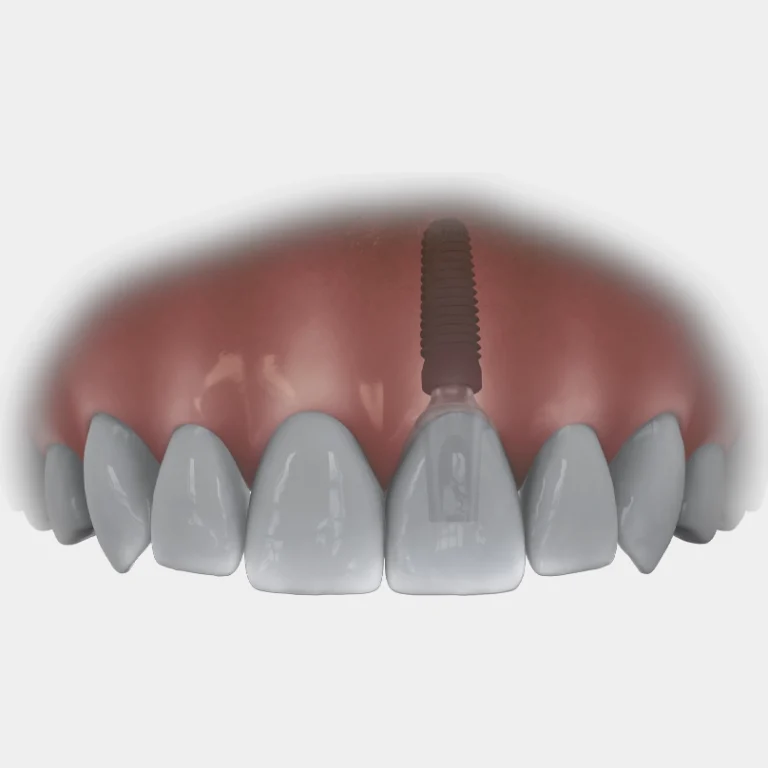 implantologie-immediat-placement