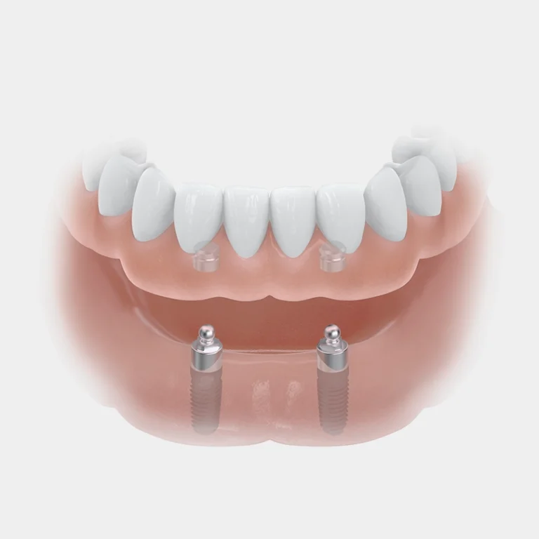 implantologie-klikgebit-implantaten